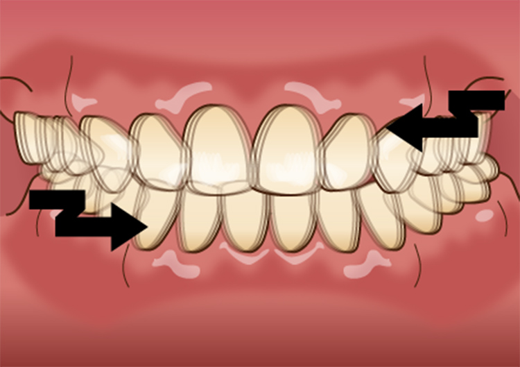 歯ぎしり、顎関節症