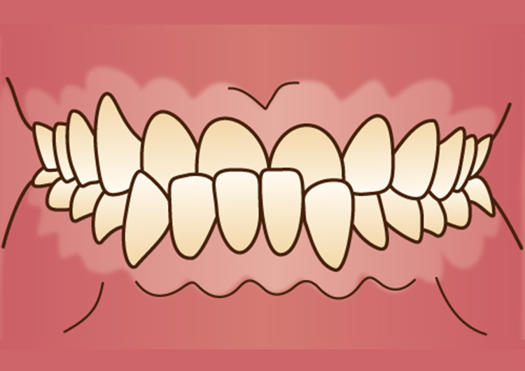 歯ぎしり、顎関節症