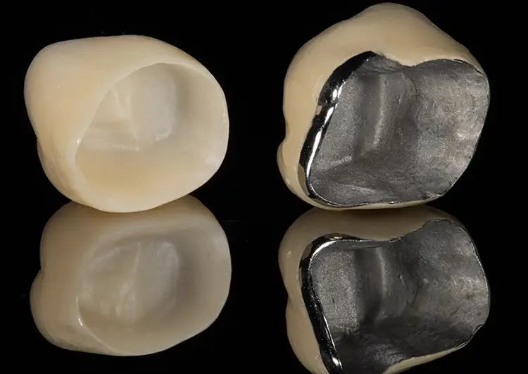 メタルボンドクラウン