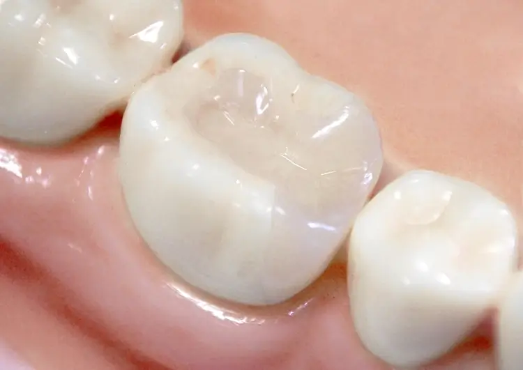 セラミックインレー