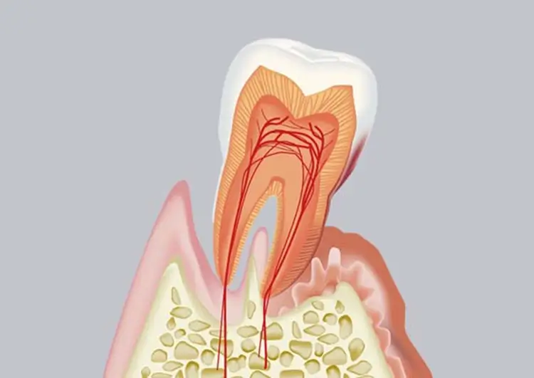 中等度歯周炎(中期〜後期段階)