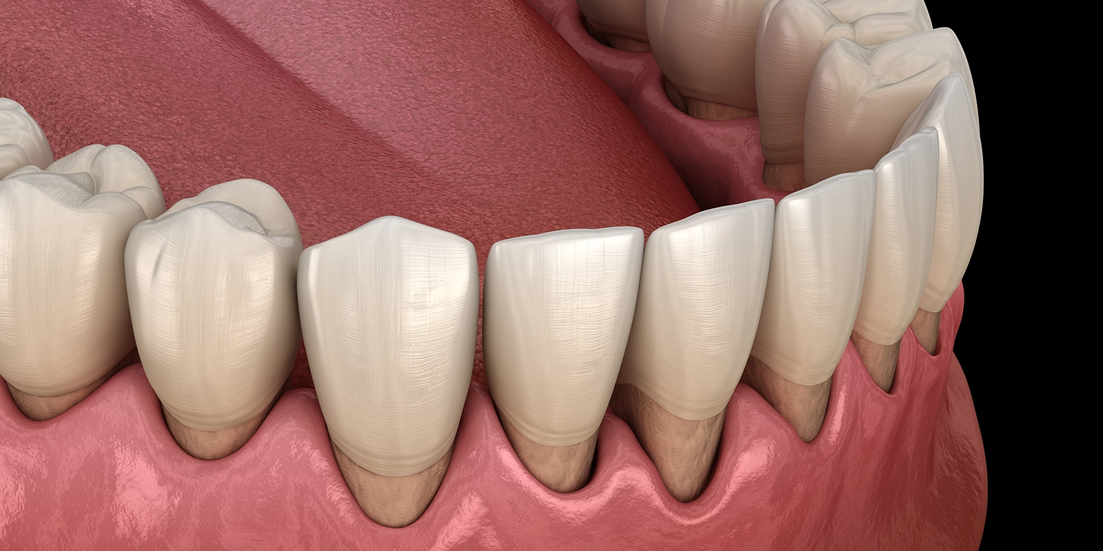 歯周病はなぜ「治療」が必要なのか、放置した場合のリスク