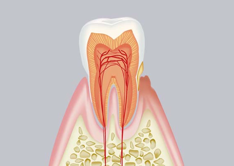 軽度の歯周病(歯肉炎〜軽度歯周炎)：スケーリングによるプラーク・歯石の除去