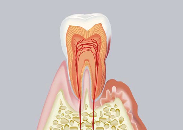 中等度の歯周病：SRP(スケーリング・ルートプレーニング)による歯根面の清掃