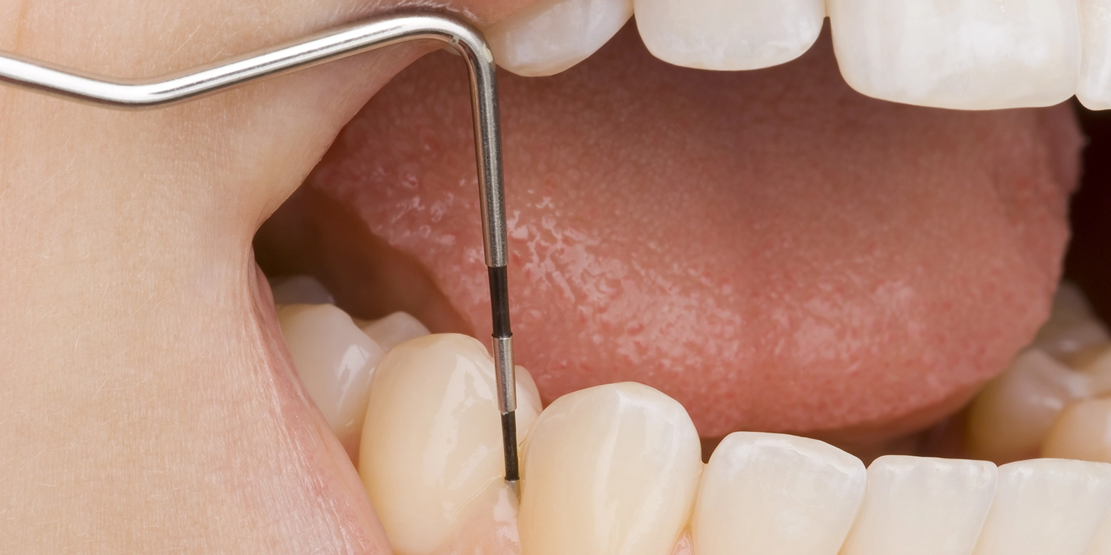 歯周病の治療期間と定期メンテナンスの重要性