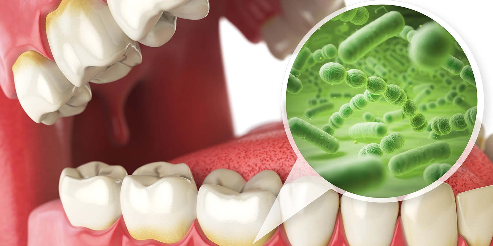 「歯周病の正体」細菌による慢性感染症