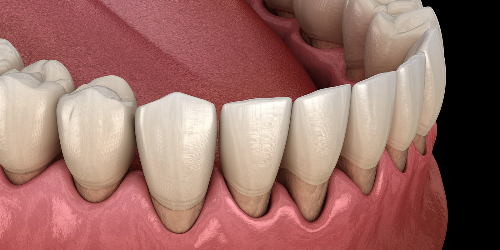 中期の症状、歯周炎に進行すると現れる変化