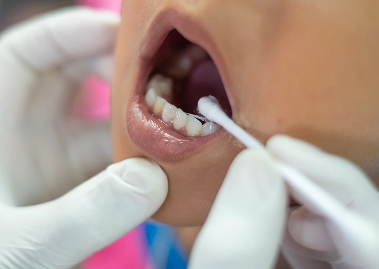 フッ化物の塗布による虫歯予防